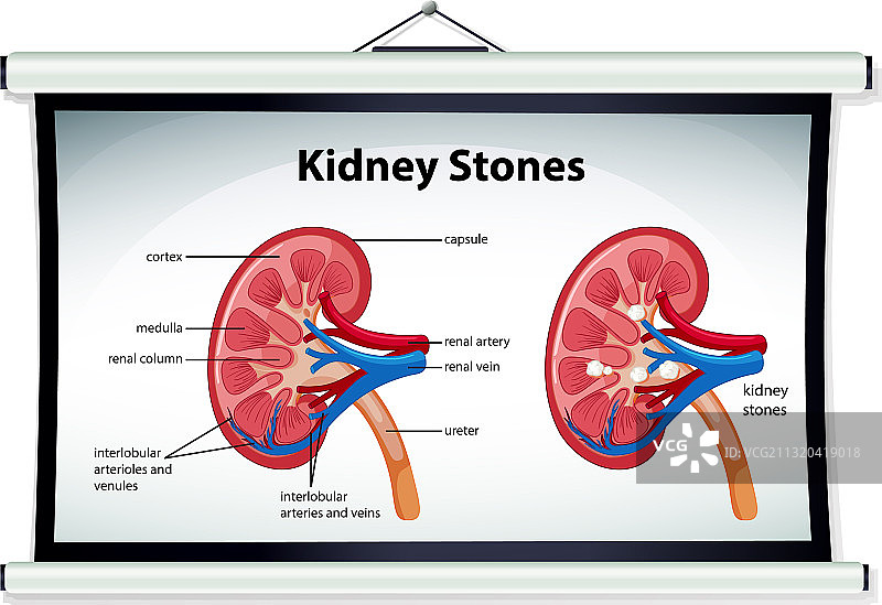 卡通风格肾结石症状信息图图片素材