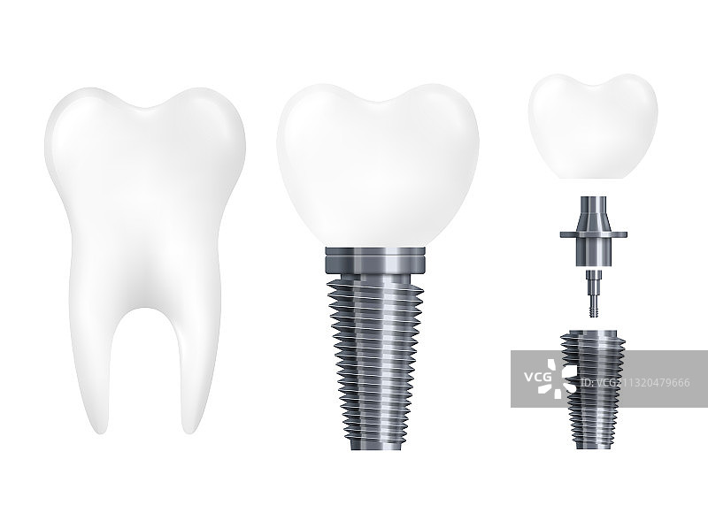 牙科植入体部件 - 逼真的白色牙齿图片素材