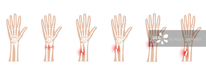 骨折X光概念图片素材