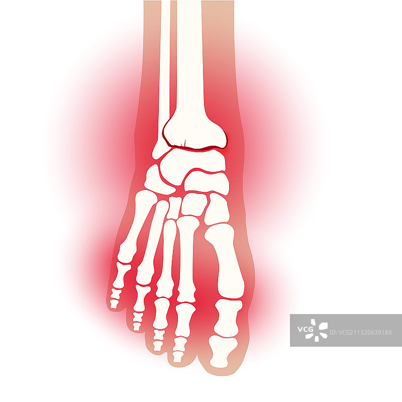 足部关节炎概念图片素材