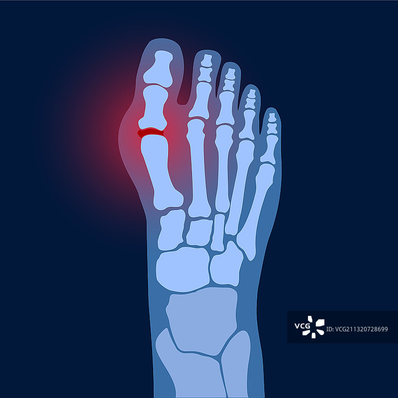 足部关节炎概念图片素材