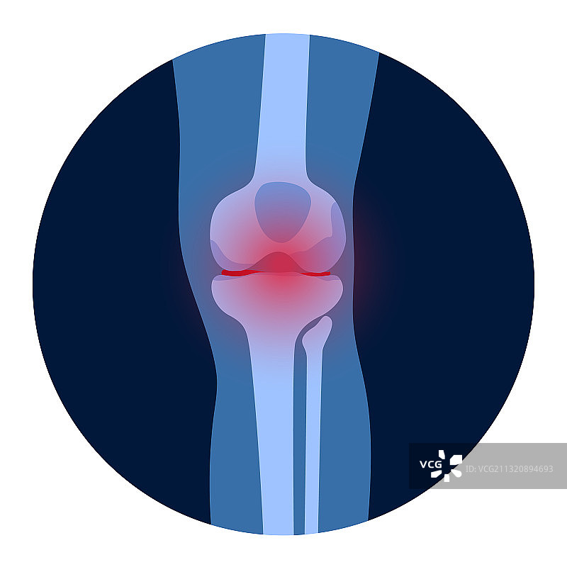 膝关节炎图片素材