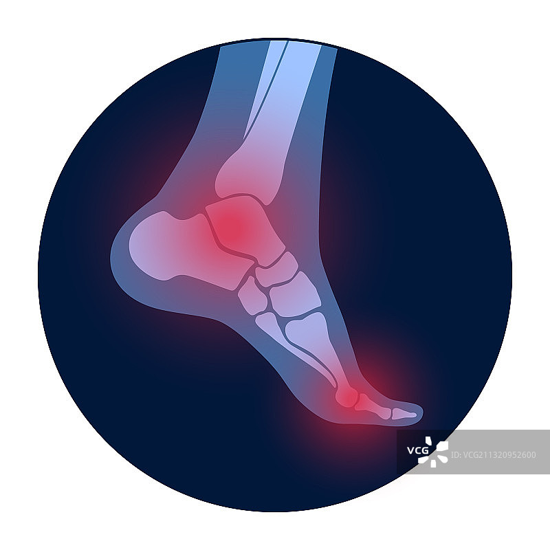 足部关节炎概念图片素材