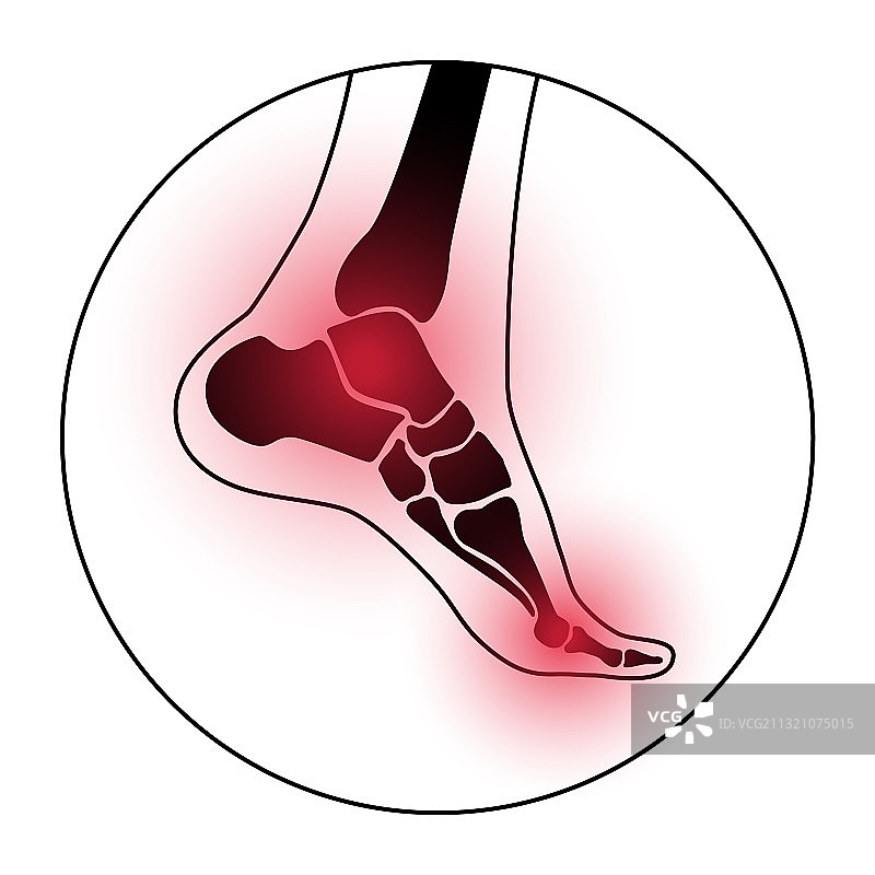 足部关节炎概念图片素材