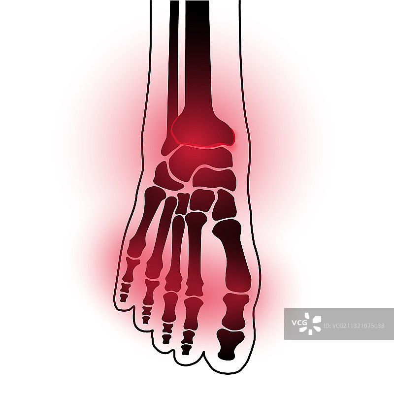 足部关节炎概念图片素材