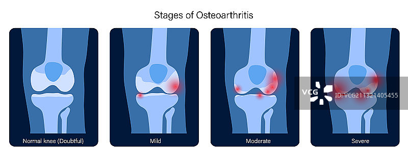 膝关节炎图片素材