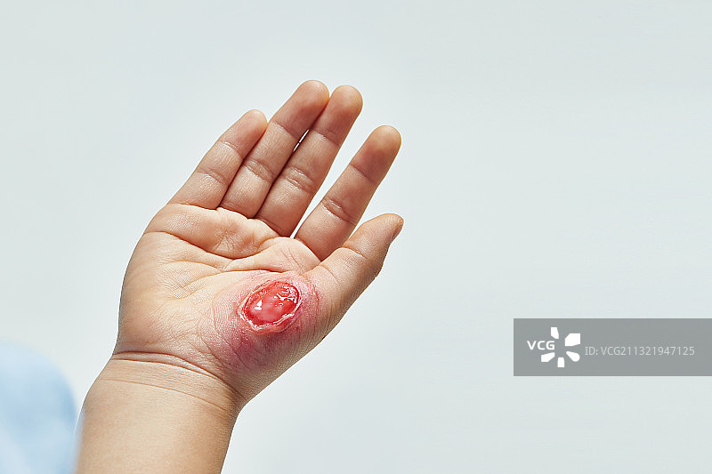 保险、伤病、伤疤、创伤、皮肤病、人体皮肤、皮肤科图片素材