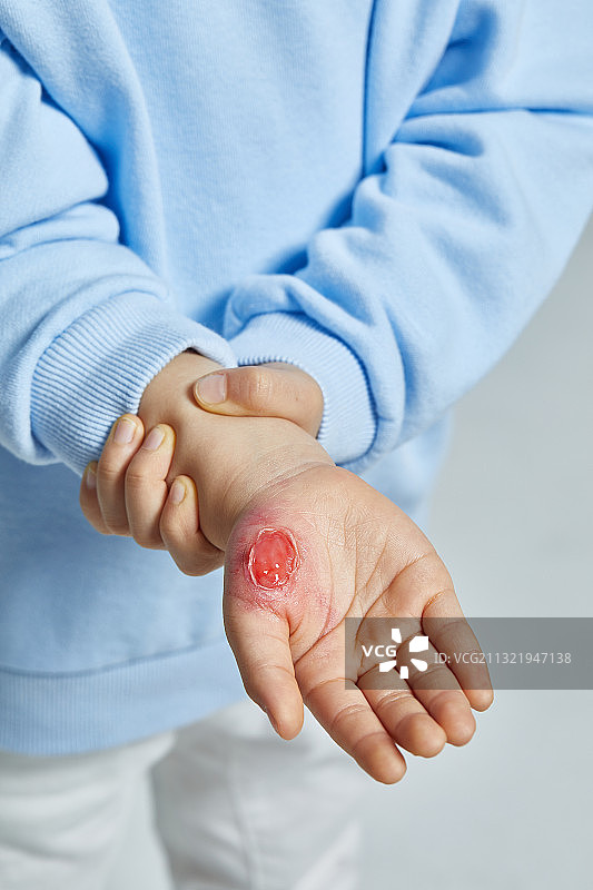 保险、伤病、伤疤、创伤、皮肤病、人体皮肤、皮肤科图片素材