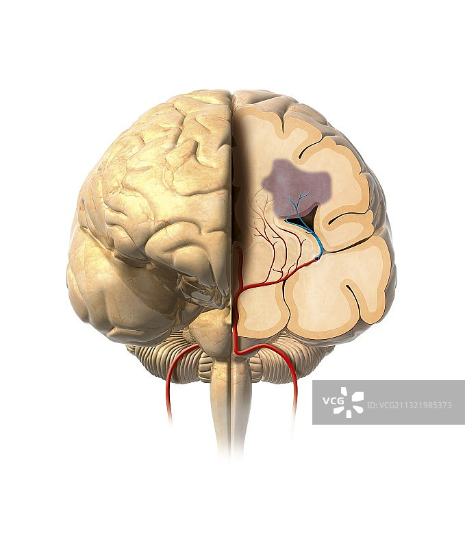 中风，艺术作品图片素材