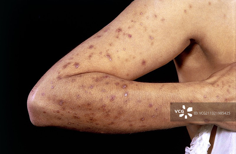 慢性活动性肝炎图片素材