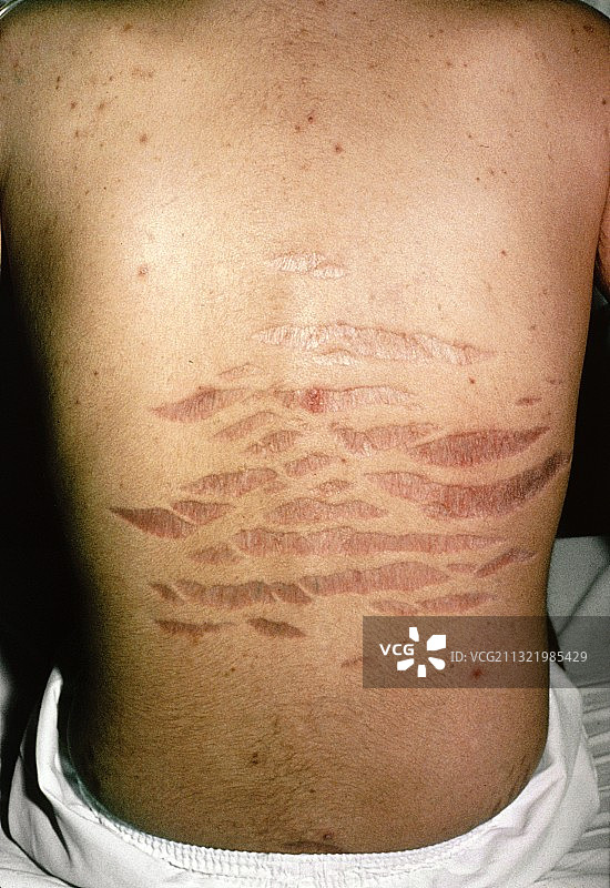 急性胰腺炎图片素材