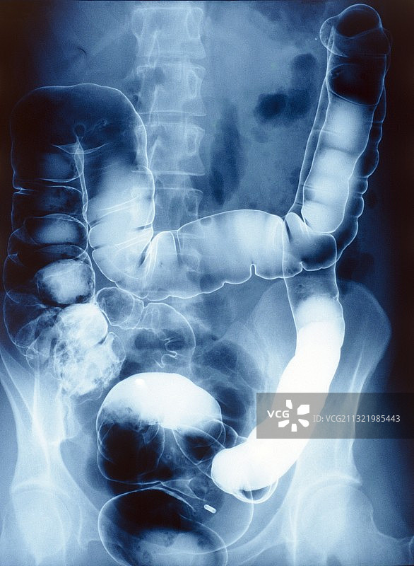 正常结肠钡剂X光片图片素材
