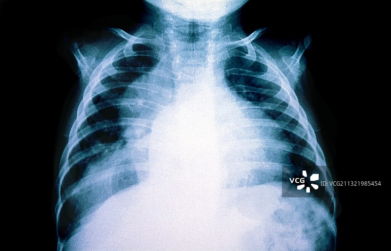 儿童食管裂孔疝X光片图片素材