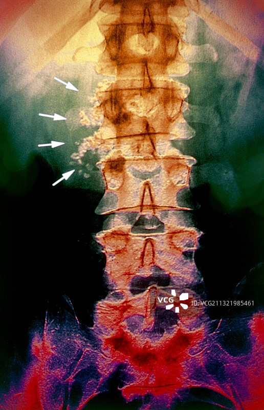 胰腺炎钙化X光片图片素材