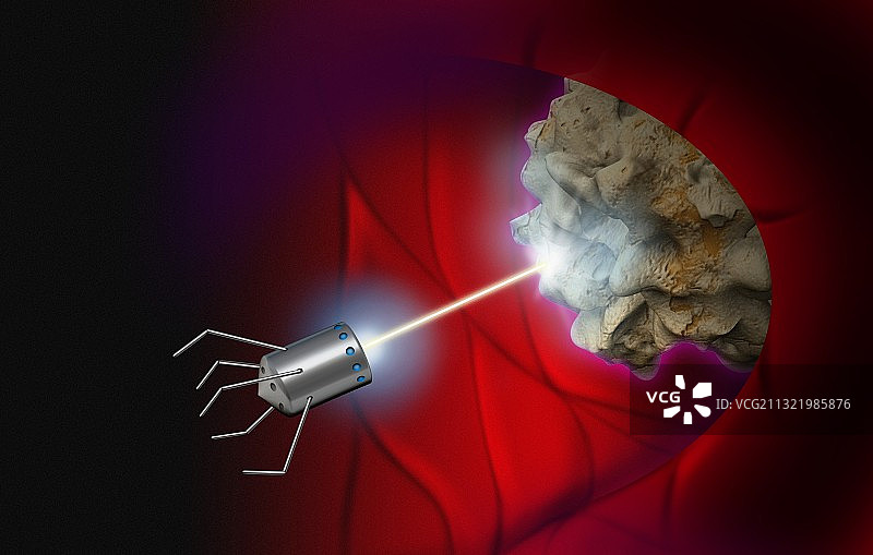 纳米机器人摧毁人体内的癌细胞图片素材