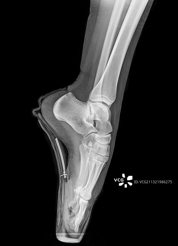 芭蕾舞者X光片图片素材