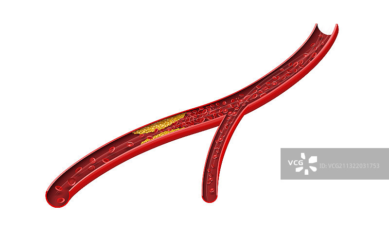 白色背景上的动脉阻塞胆固醇图片素材