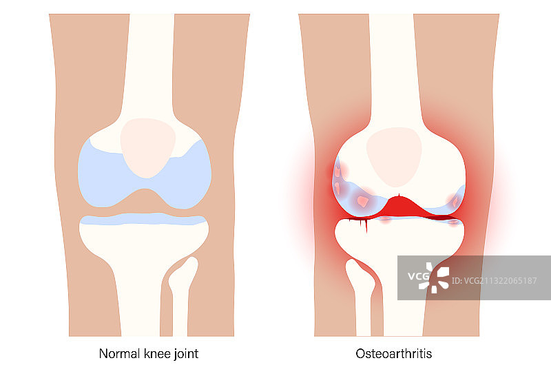 膝关节炎图片素材