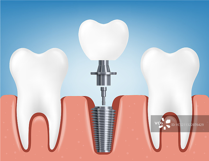 安装牙科植入体3D示意图片素材