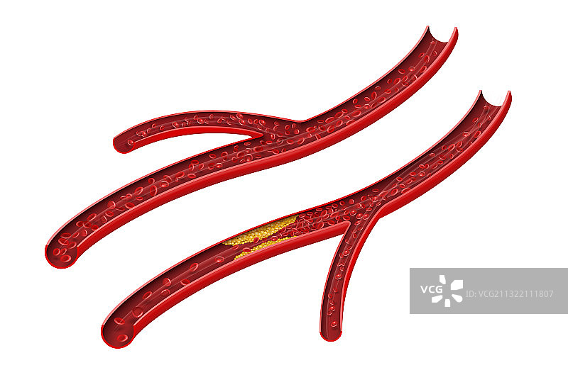 正常和胆固醇阻塞的动脉图片素材