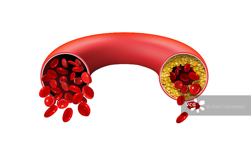 白色背景上的正常动脉和胆固醇阻塞动脉图片素材