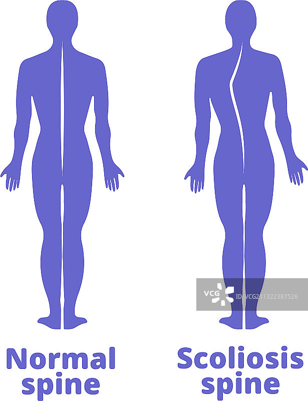 脊柱侧弯蓝色人体疾病图片素材