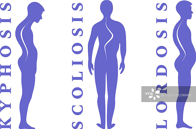 脊柱侧弯和前凸图片素材