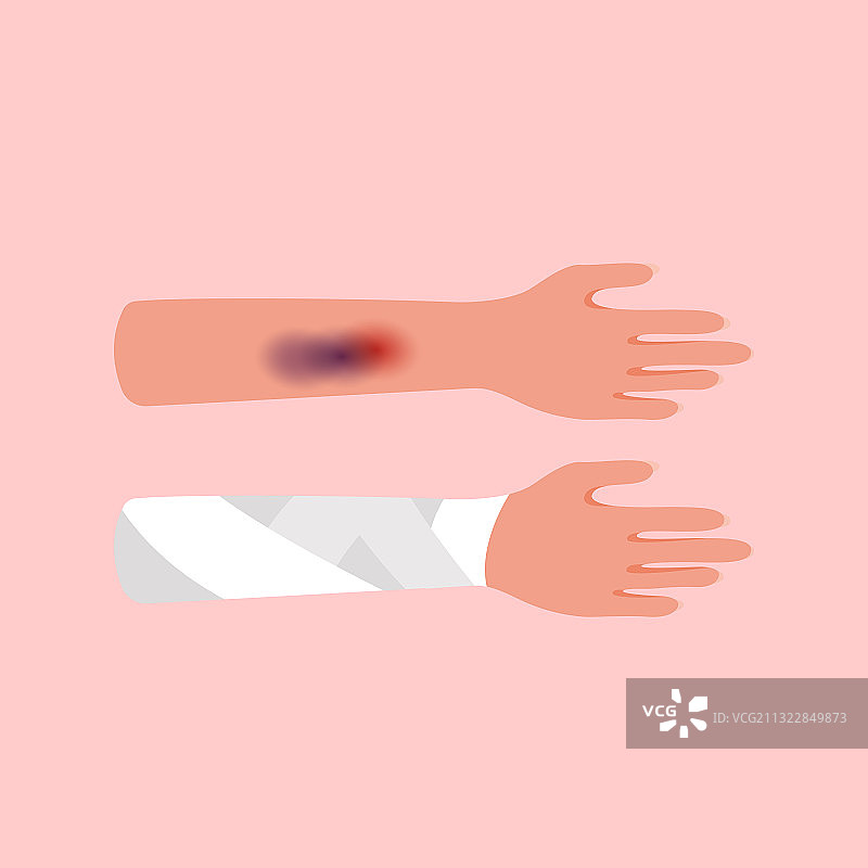 手臂弹性绷带上的严重损伤或瘀伤图片素材