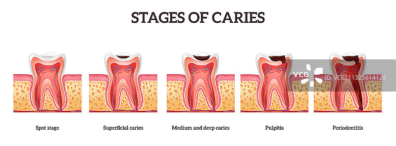 牙齿损坏阶段图片素材