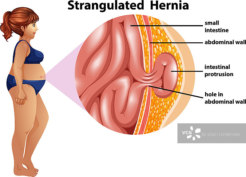 绞窄性疝气信息图图片素材