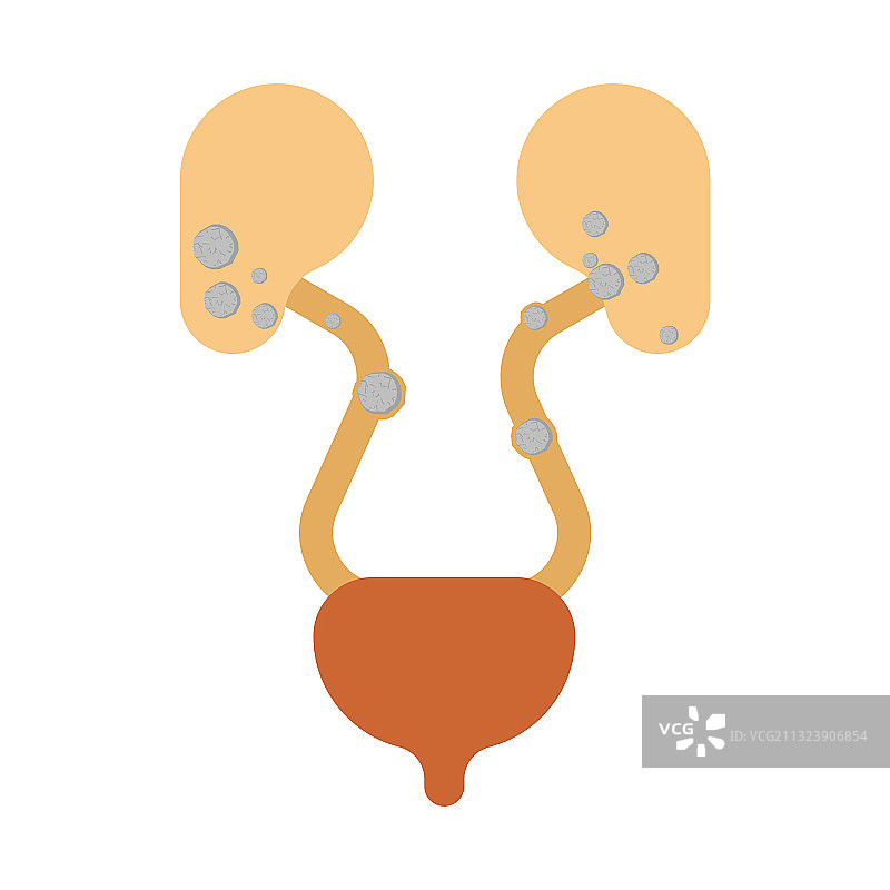 肾结石图片素材