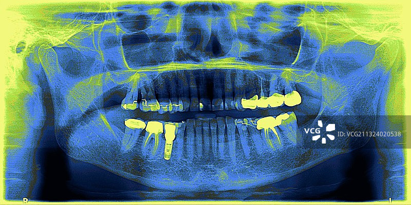 彩色颌骨X光片：显示种植体和牙冠图片素材