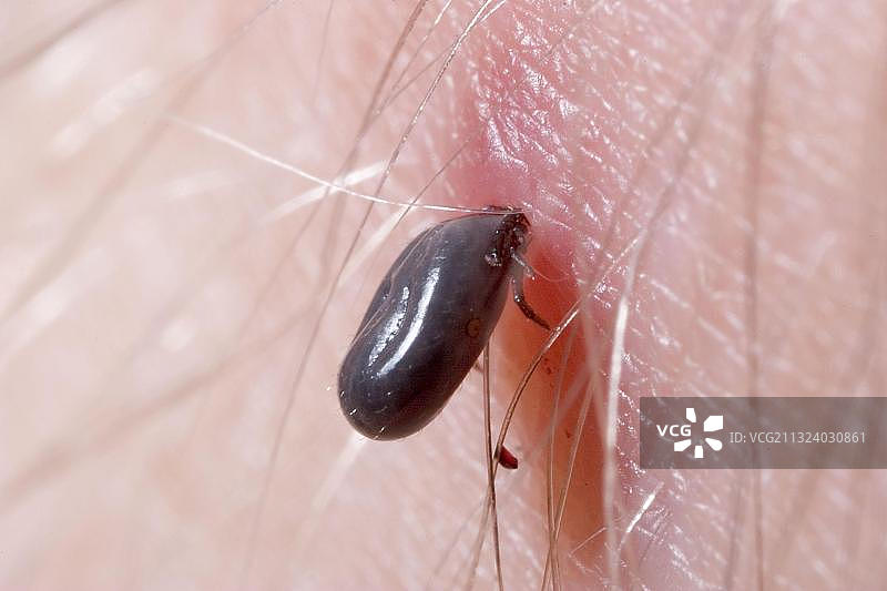 德国欧洲人皮肤上的蜱虫（蓖麻硬蜱）图片素材