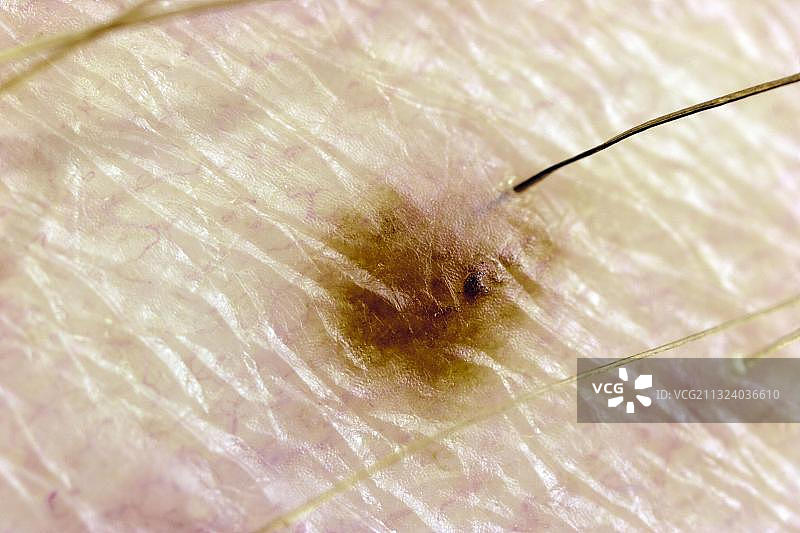 人皮肤上常见蓖麻豆壁虱（全沟硬蜱）的咬痕，蜱虫叮咬部位图片素材