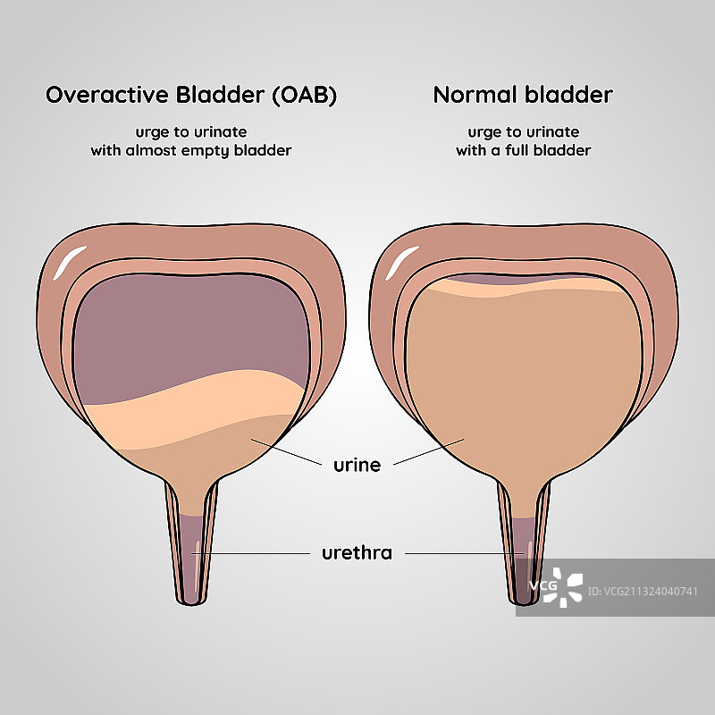 膀胱过度活动症和正常泌尿系统图片素材