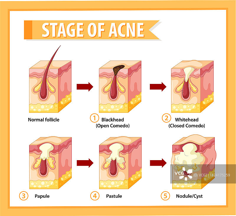 皮肤痤疮解剖阶段图片素材