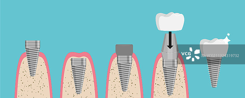牙科植入安装阶段图片素材