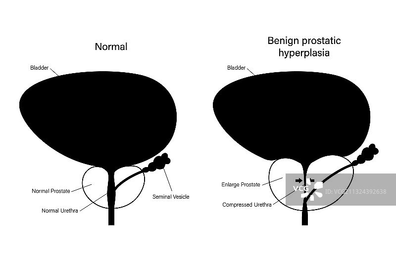BPH信息概念图片素材