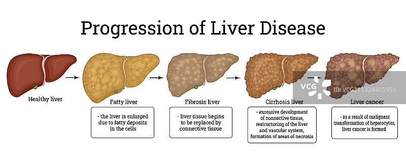 肝损伤的各个阶段图片素材