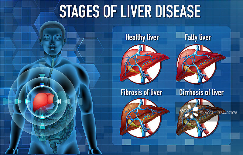 肝脏疾病阶段图片素材