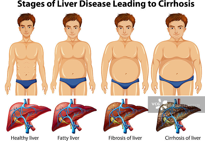 导致肝硬化的肝病阶段图片素材