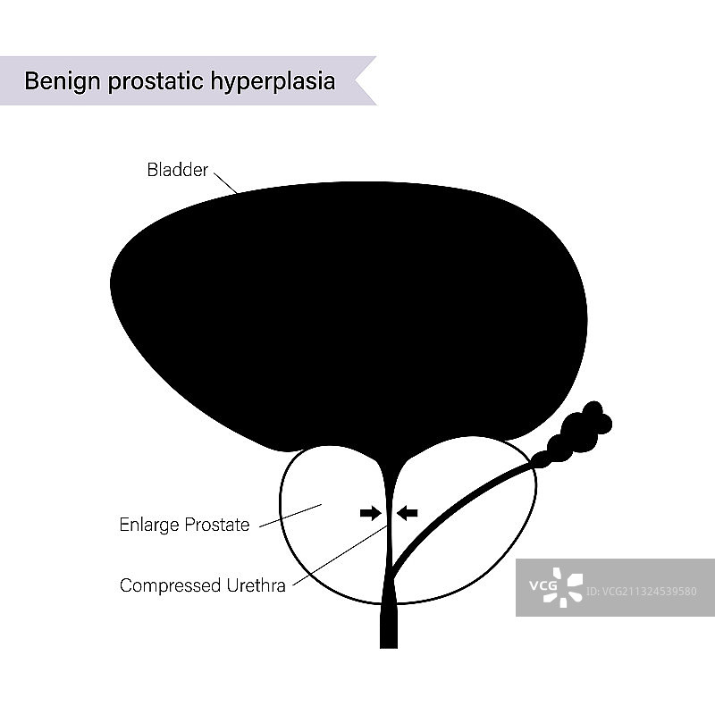BPH信息概念图片素材