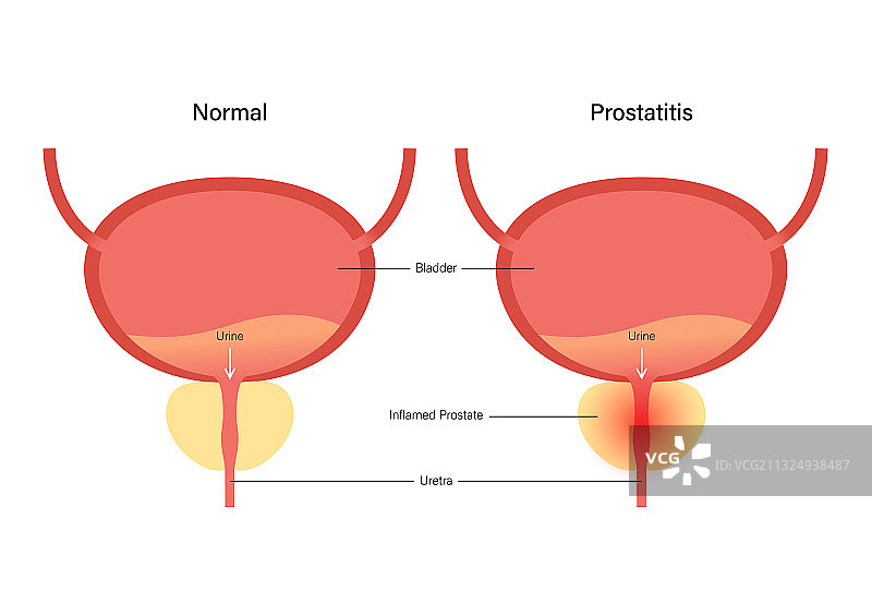 前列腺炎炎症问题图片素材