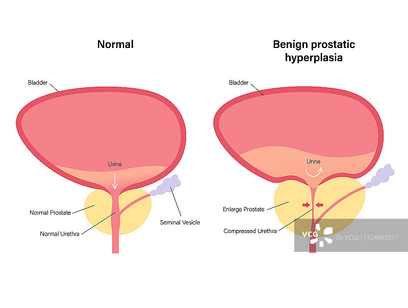 BPH信息概念图片素材