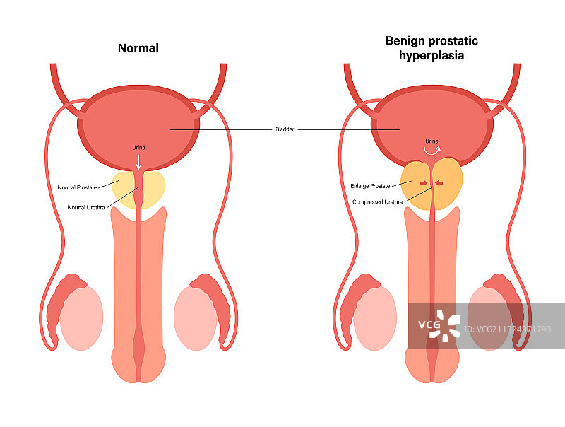 BPH信息概念图片素材