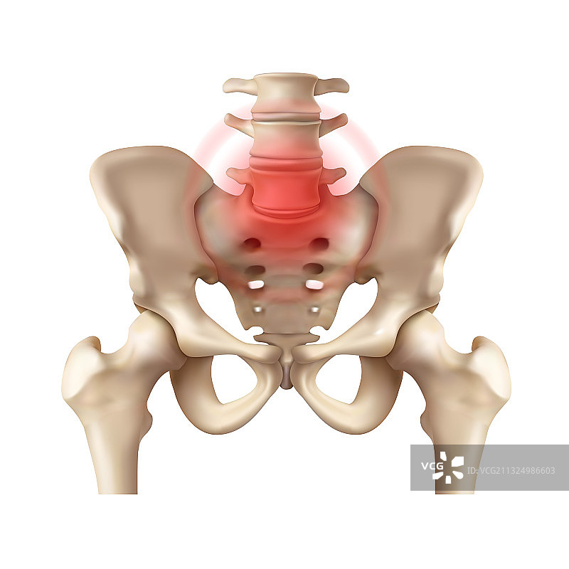 强直性脊柱炎图片素材