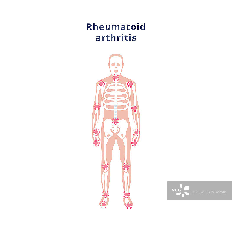 人体骨骼疼痛来源海报图片素材