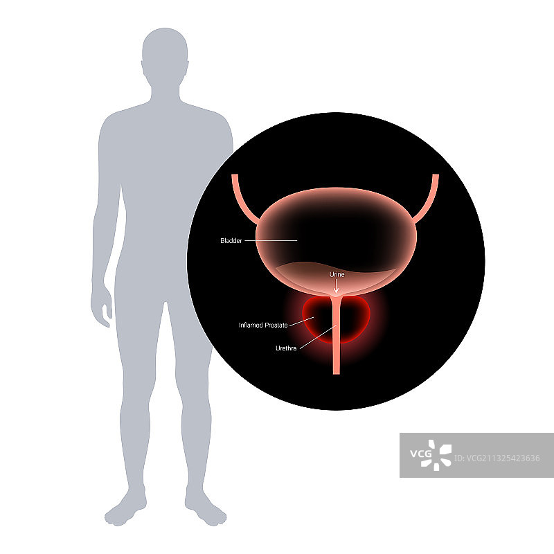 前列腺炎炎症问题图片素材