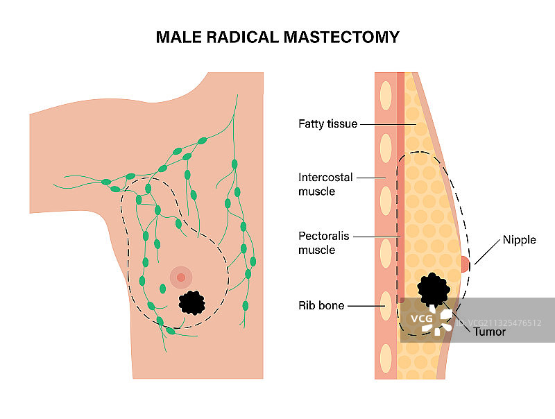 乳腺疾病概念图片素材