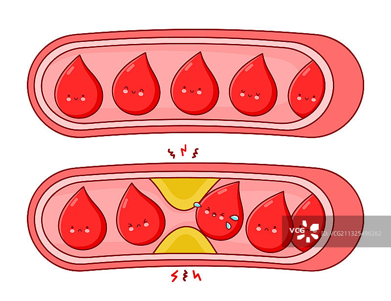 正常和阻塞的血管图片素材